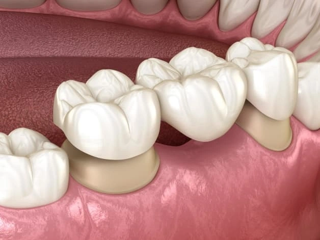 Tiêu Xương Hàm Sau Khi Mất Răng! Nhiều Người Không Nhận Ra 11 Cầu răng sứ