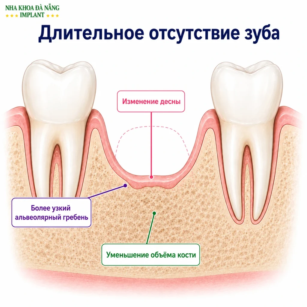 Резорбция костной ткани челюсти при длительном отсутствии зуба
