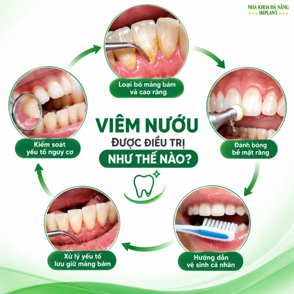 Điều Trị Viêm Nướu Sớm Giúp Tránh Những Biến Chứng Nào? 9 Viêm nướu được điều trị như thế nào