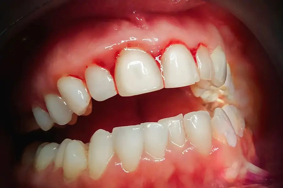 Điều Trị Viêm Nướu Sớm Giúp Tránh Những Biến Chứng Nào? 8 Nướu bị sưng đỏ