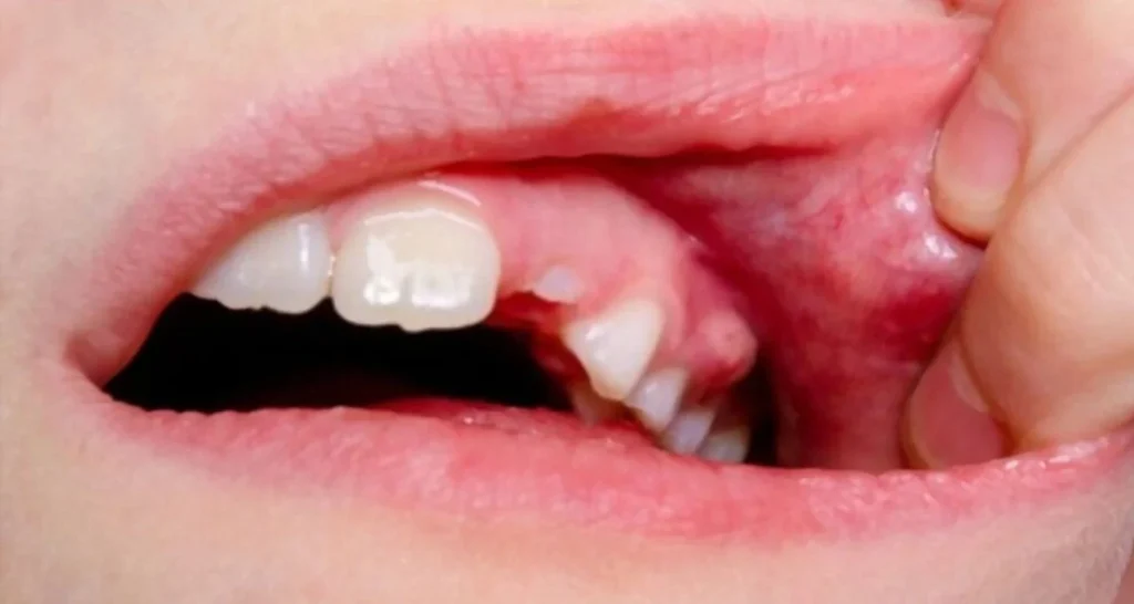 Điều Trị Viêm Nướu Sớm Giúp Tránh Những Biến Chứng Nào? 7 Phòng ngừa túi nha chu và áp-xe nướu