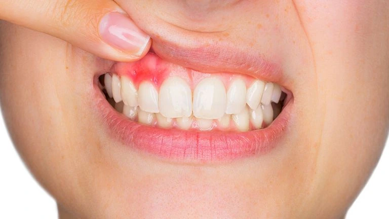 Điều Trị Viêm Nướu Sớm Giúp Tránh Những Biến Chứng Nào? 6 Dấu hiệu viêm nướu sớm