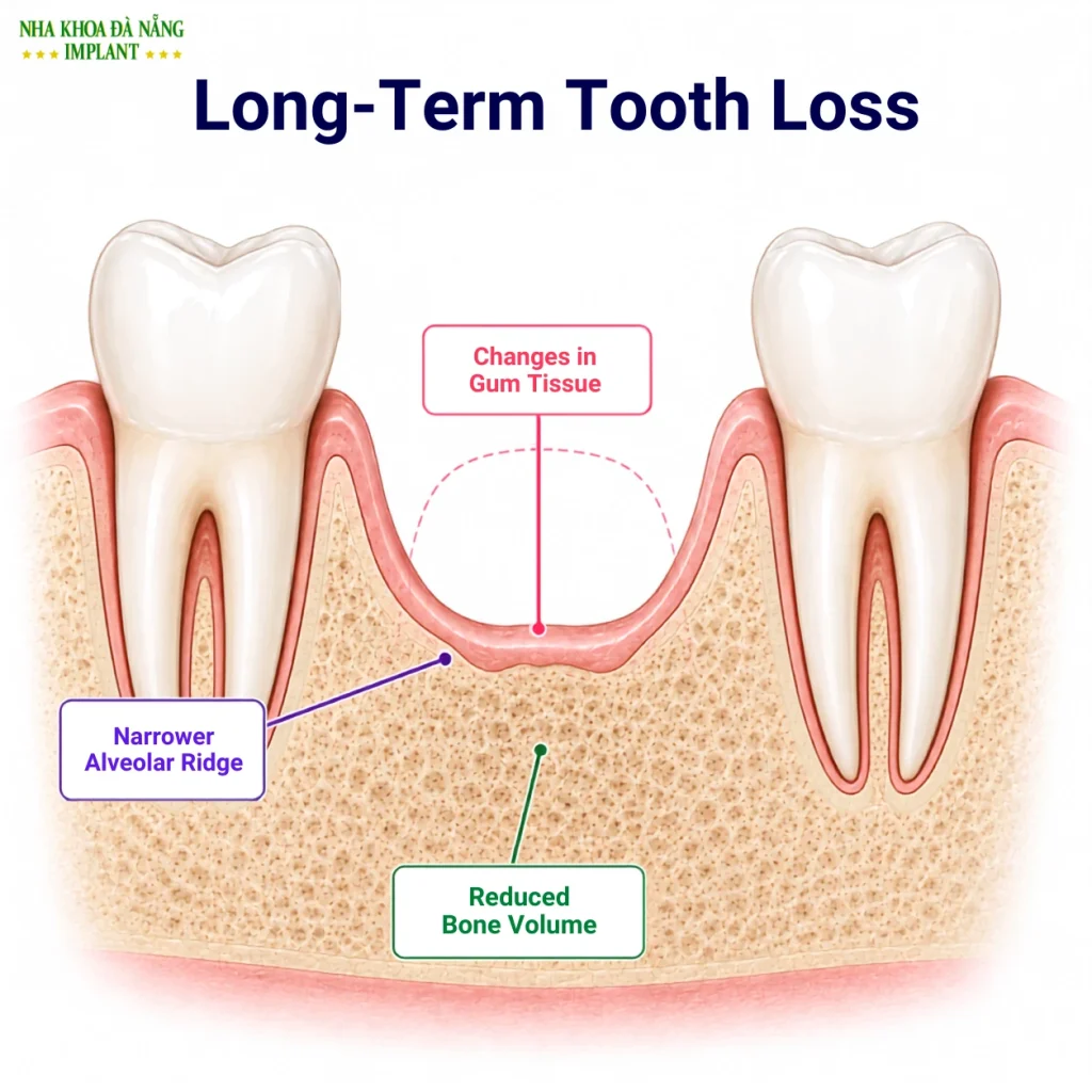 Jawbone Resorption After Long-Term Tooth Loss