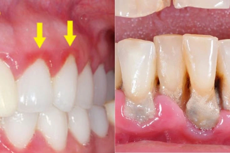 Vì Sao Phải Đến Nha Khoa Kiểm Tra Răng Miệng Định Kỳ? 10 Viêm nướu và viêm nha chu