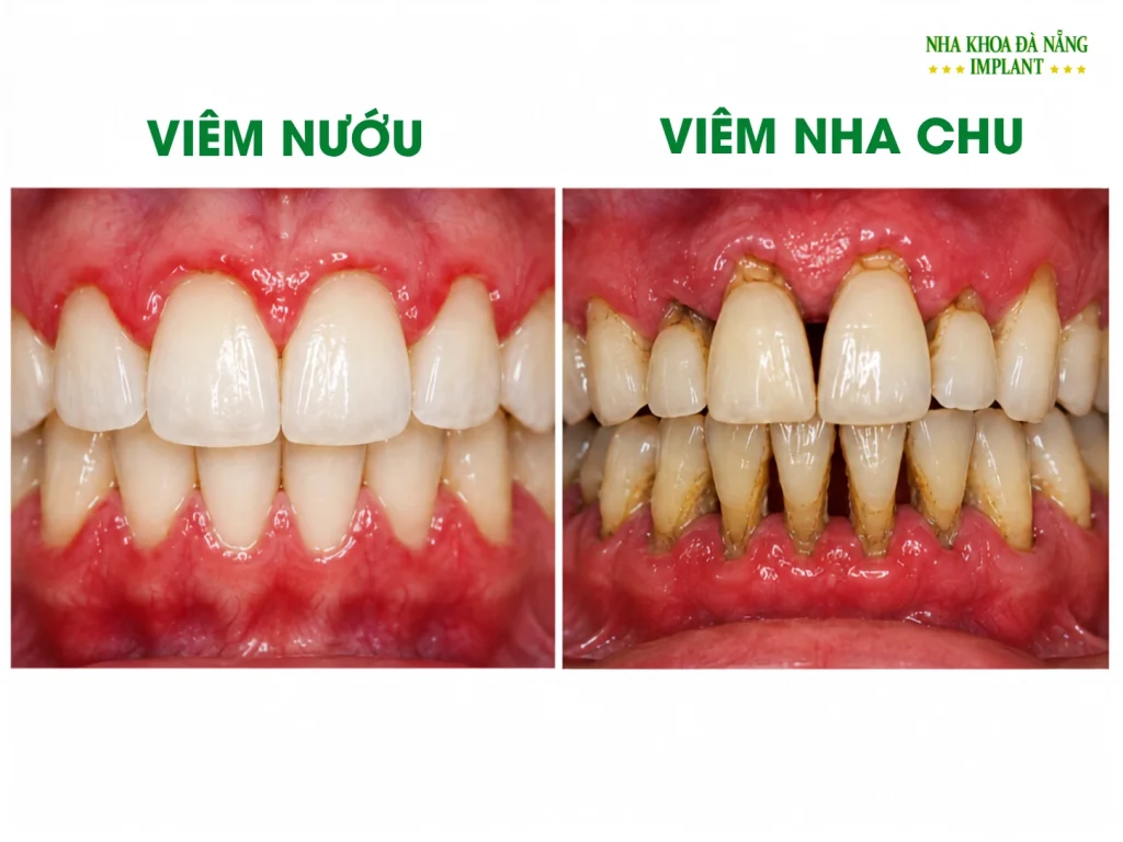 Hình ảnh viêm Nướu và viêm Nha Chu