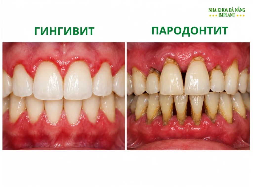 Неприятный запах изо рта даже при тщательной чистке зубов: 7 причин, которые часто остаются незамеченными 8 гингивит или пародонтит