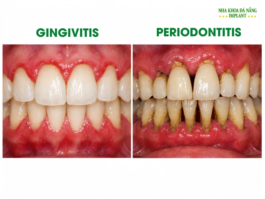 Hidden Gingivitis or Periodontitis