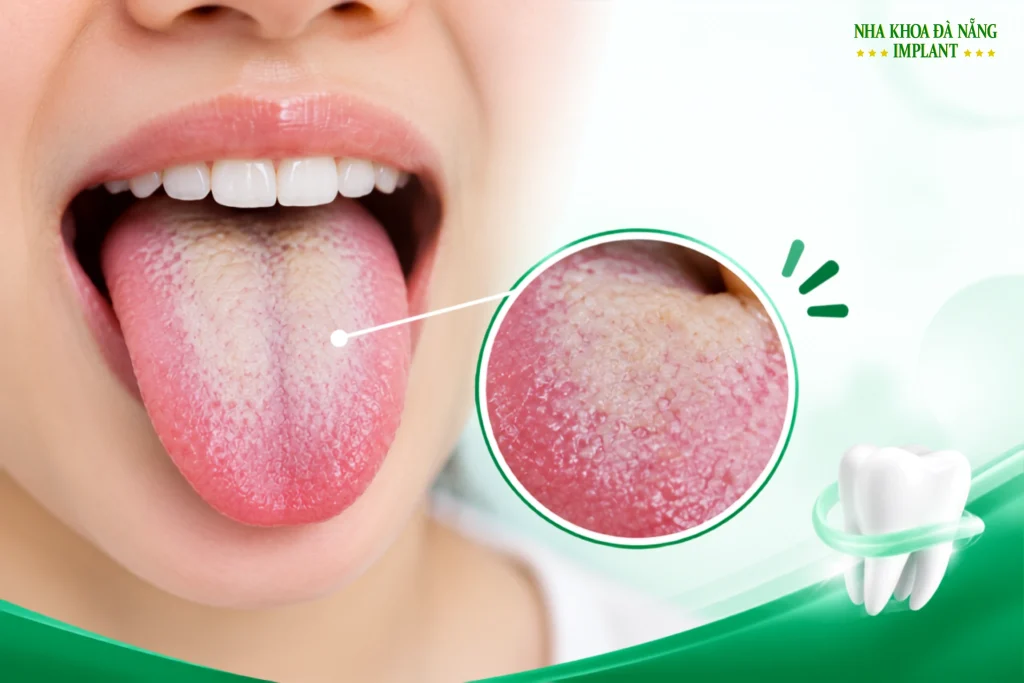 Mảng bám trên lưỡi chưa được làm sạch