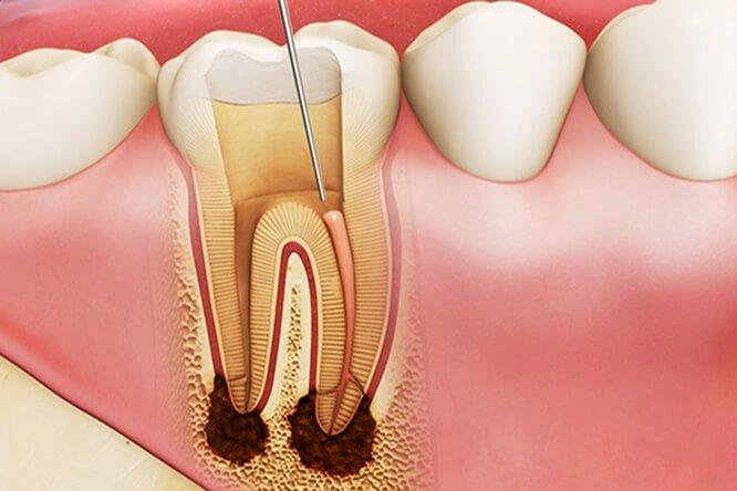 Răng đã chữa tủy nhưng vẫn có khả năng điều trị lại