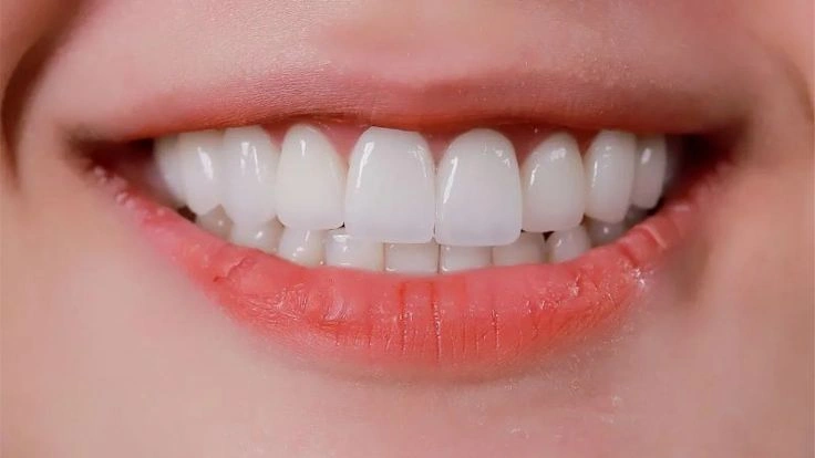 Dán sứ Veneer có làm hỏng răng thật không?