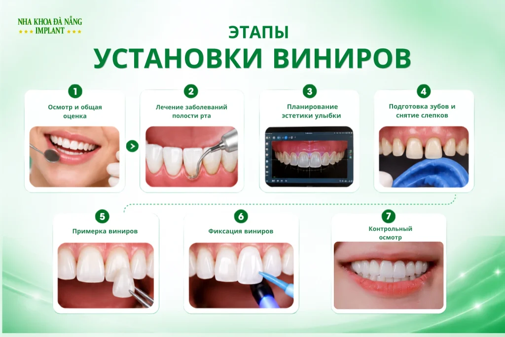 Безопасны ли виниры? Отзывы и реальный опыт 7 Какие этапы должен включать безопасный протокол установки виниров?