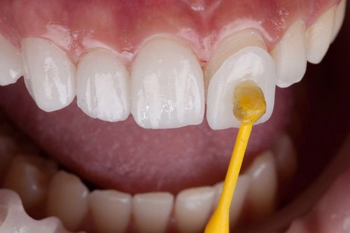 Dán sứ Veneer là gì?