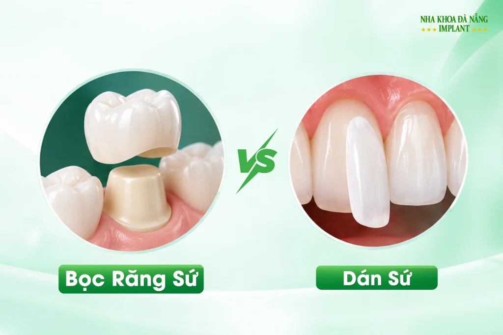 Bọc răng sứ hay dán sứ