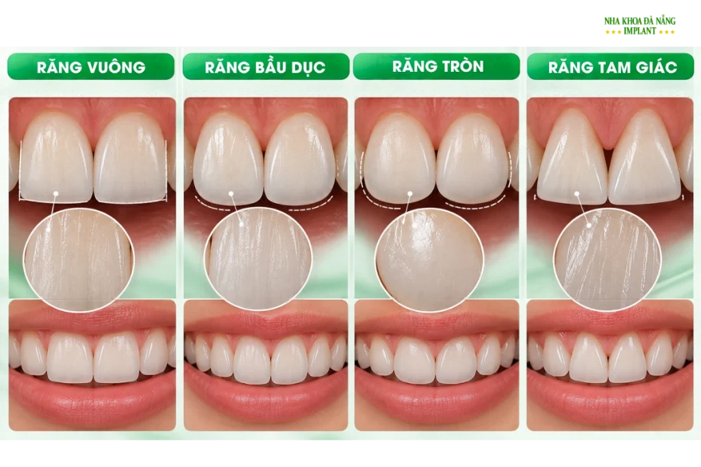 Làm Răng Sứ Một Chiếc: Làm Sao Để Hài Hòa Với Các Răng Bên Cạnh? 11 Hình dáng, kích thước và bề mặt răng