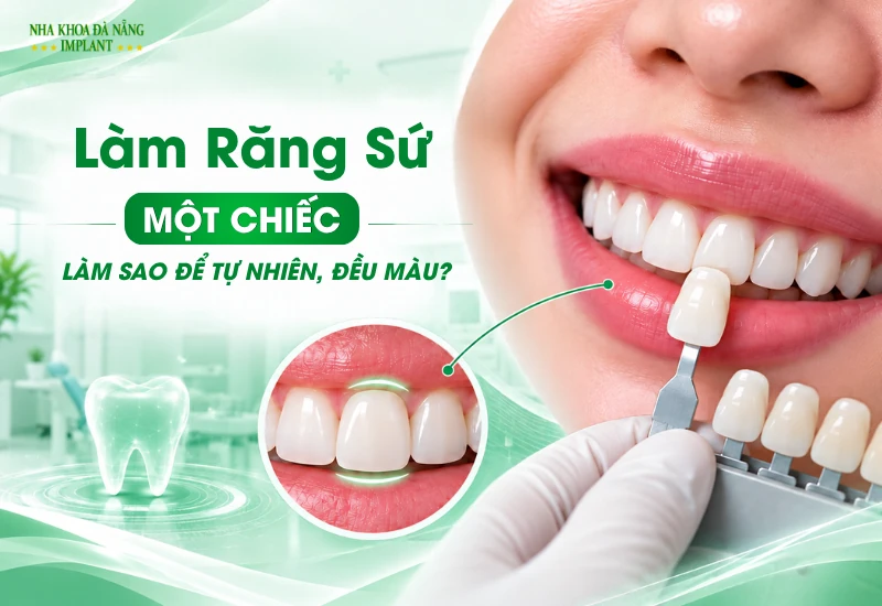 Làm Răng Sứ Một Chiếc: Làm Sao Để Hài Hòa Với Các Răng Bên Cạnh?