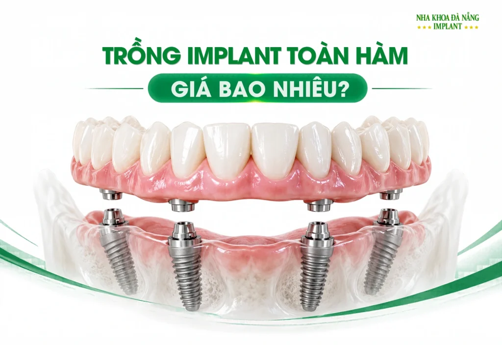 Chi Phí Trồng Implant Toàn Hàm All-on