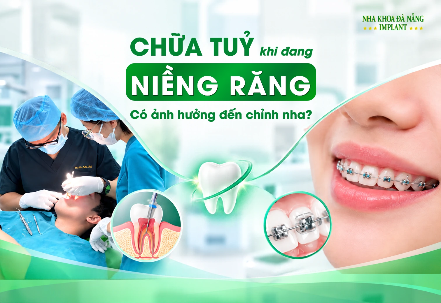 Chữa Tủy Khi Đang Niềng Răng: Có Ảnh Hưởng Đến Kết Quả Chỉnh Nha?