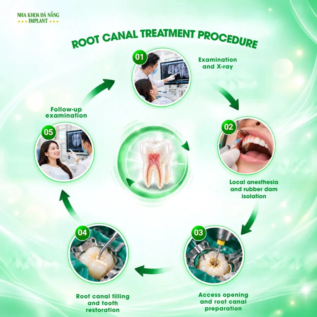 What Are the Typical Steps of Root Canal Treatment