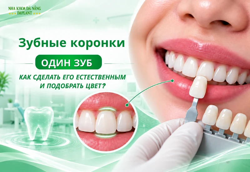 Коронка на один зуб: как добиться естественного вида и совпадения цвета?
