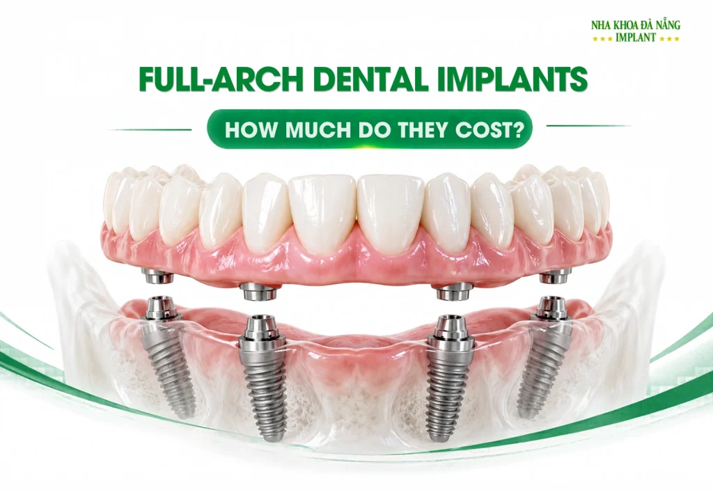 Full-Arch All-on Dental Implant Costs