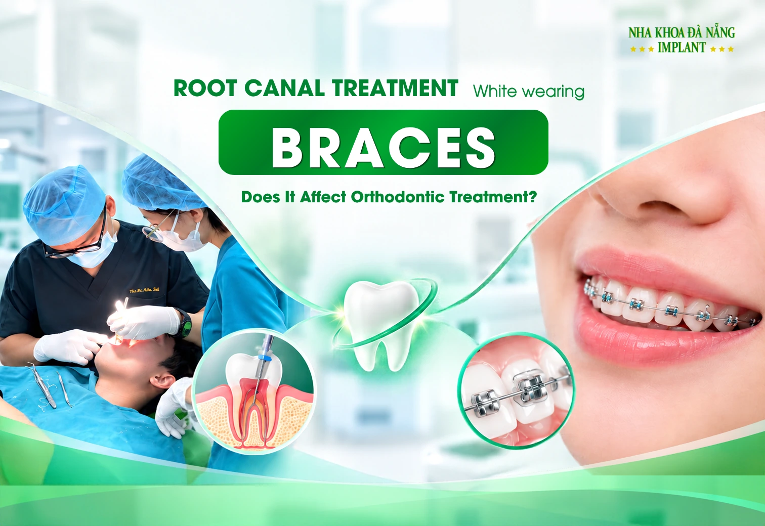 Root Canal Treatment During Braces: Does It Affect Orthodontic Treatment?