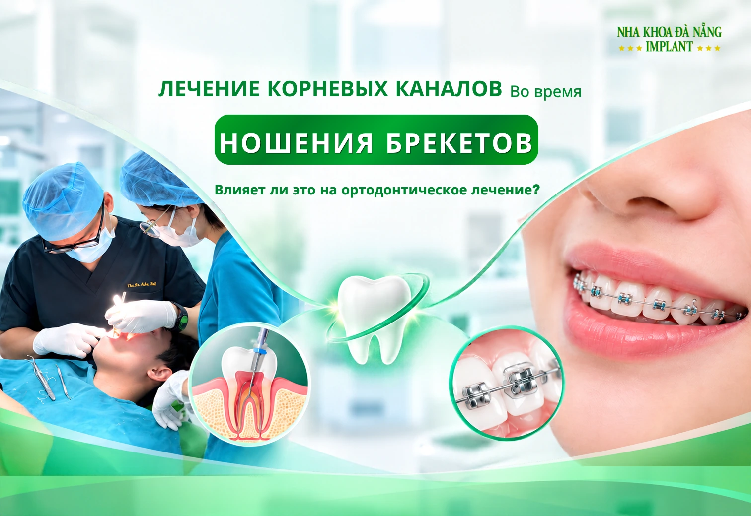 Лечение Корневых Каналов Во Время Ношения Брекетов: Влияет Ли Это На Ортодонтическое Лечение?