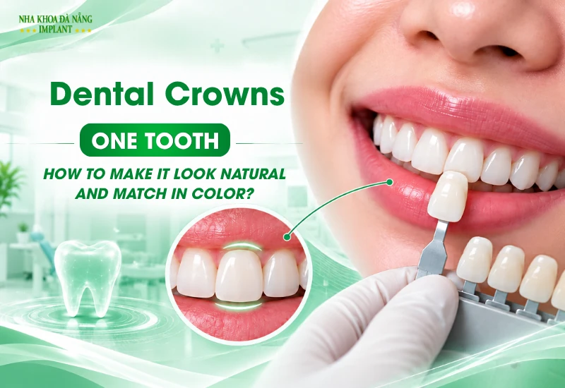 Single-Tooth Dental Crown: How Can It Look Natural and Match Your Other Teeth?