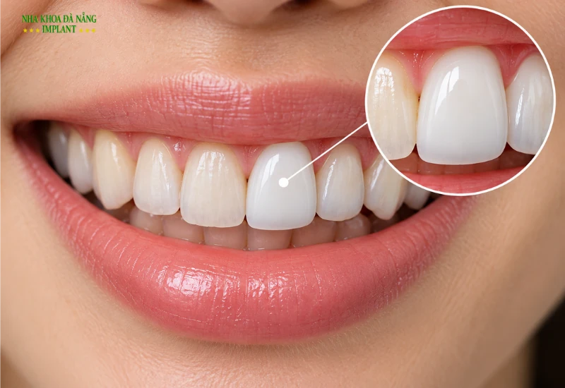 Làm Răng Sứ Một Chiếc: Làm Sao Để Hài Hòa Với Các Răng Bên Cạnh? 9 Vì sao một chiếc răng sứ dễ bị nhận ra
