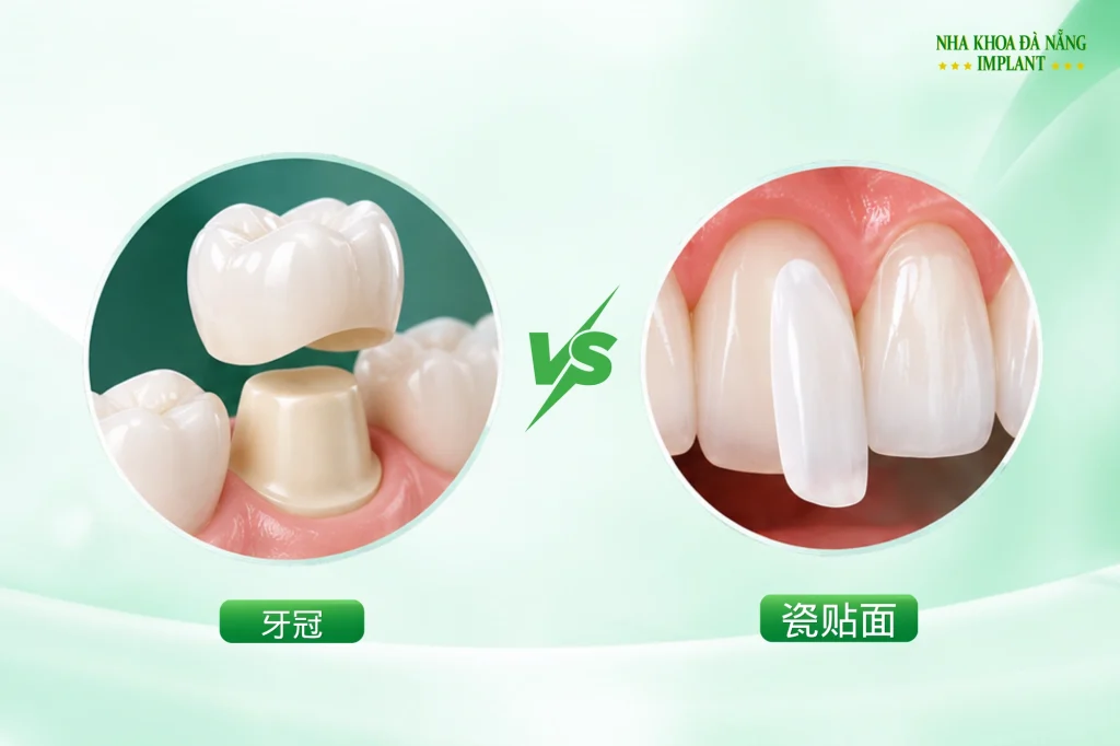 牙冠和瓷贴面