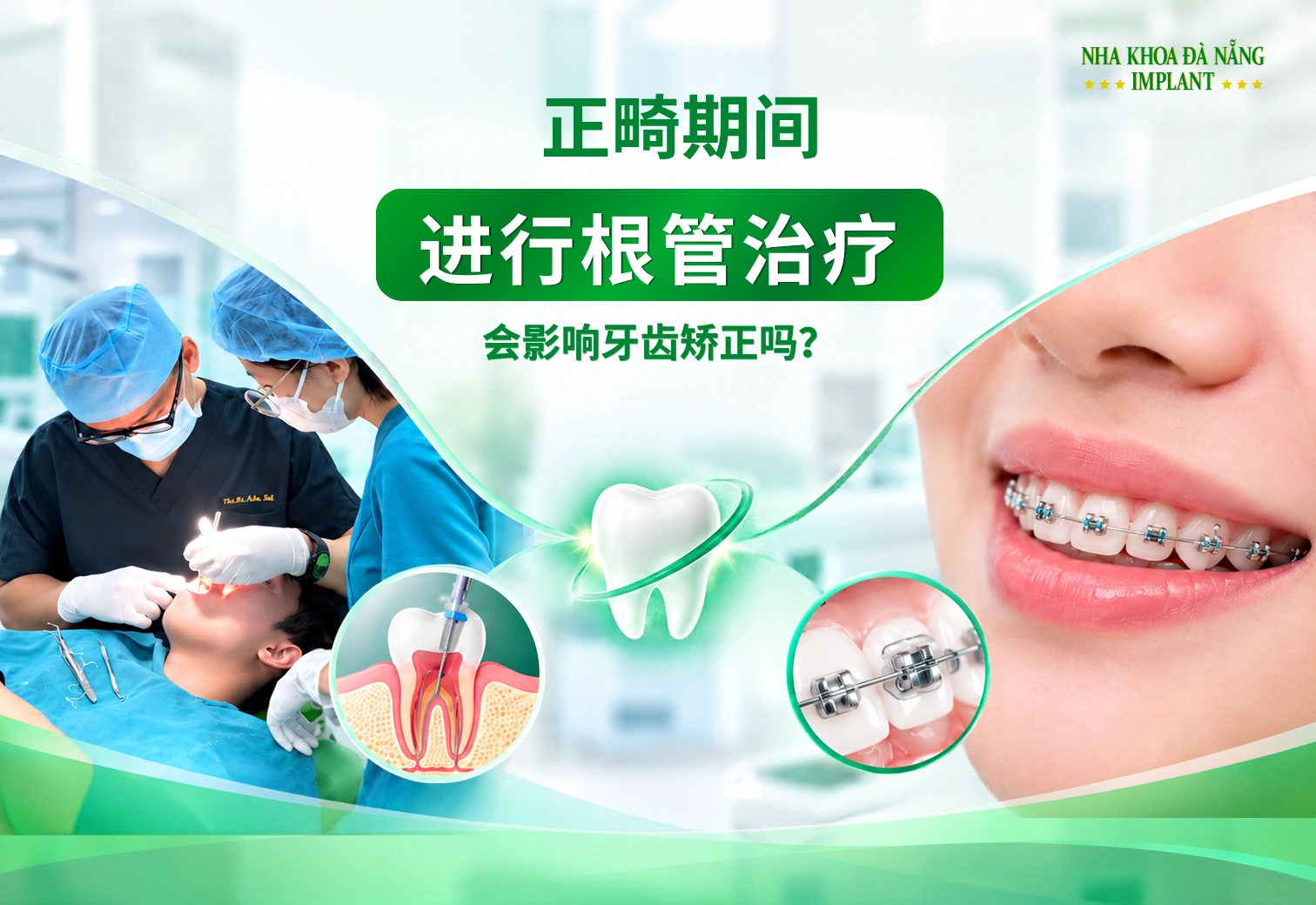 戴牙套期间做根管治疗：会影响正畸治疗吗？