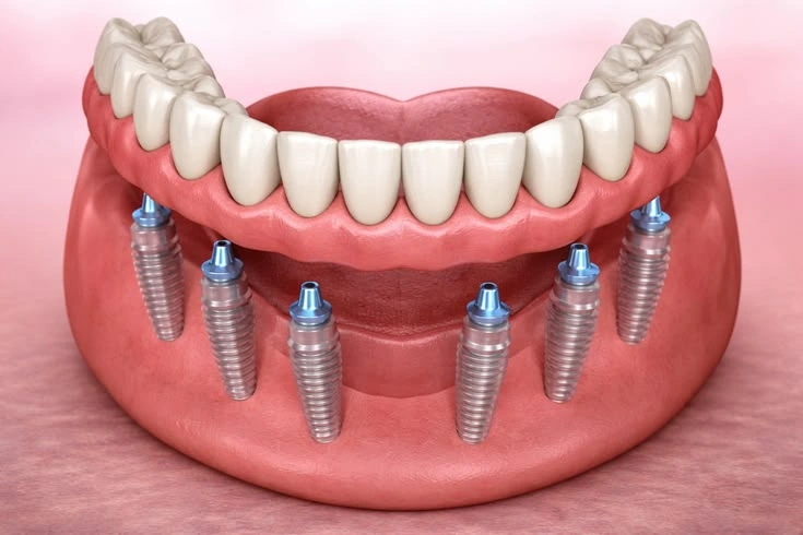 Implant toàn hàm All-on-6