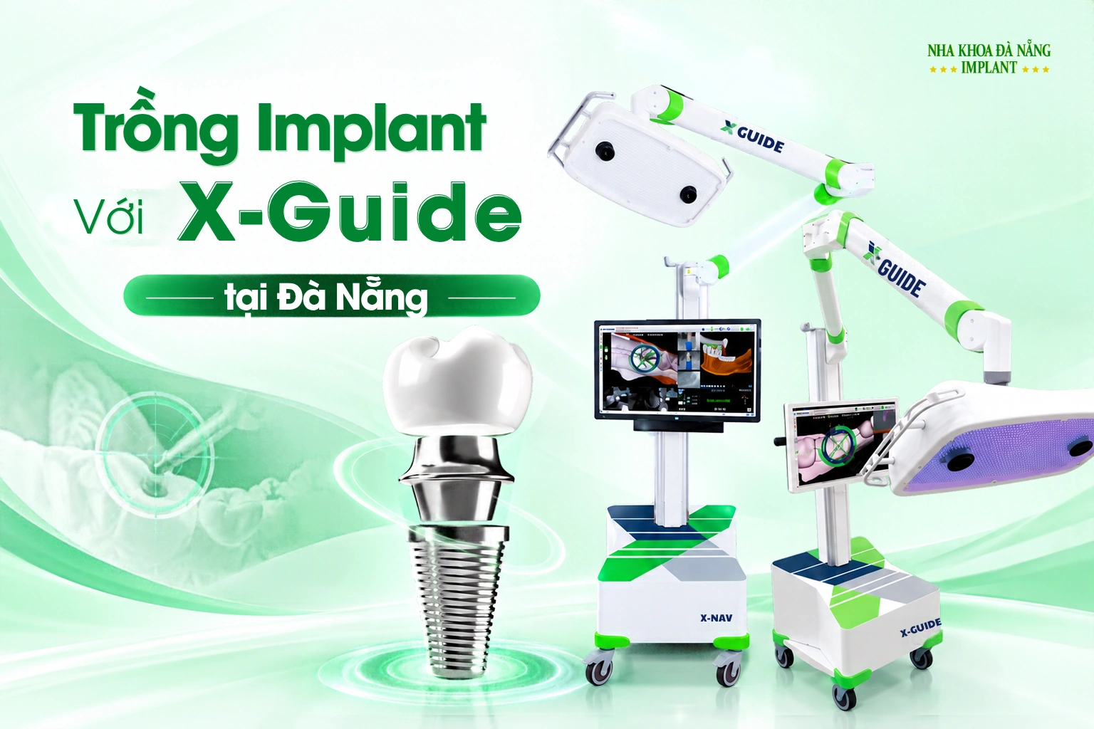 Trồng Implant với X-Guide tại Đà Nẵng: Vai trò công nghệ trong kế hoạch phục hồi răng