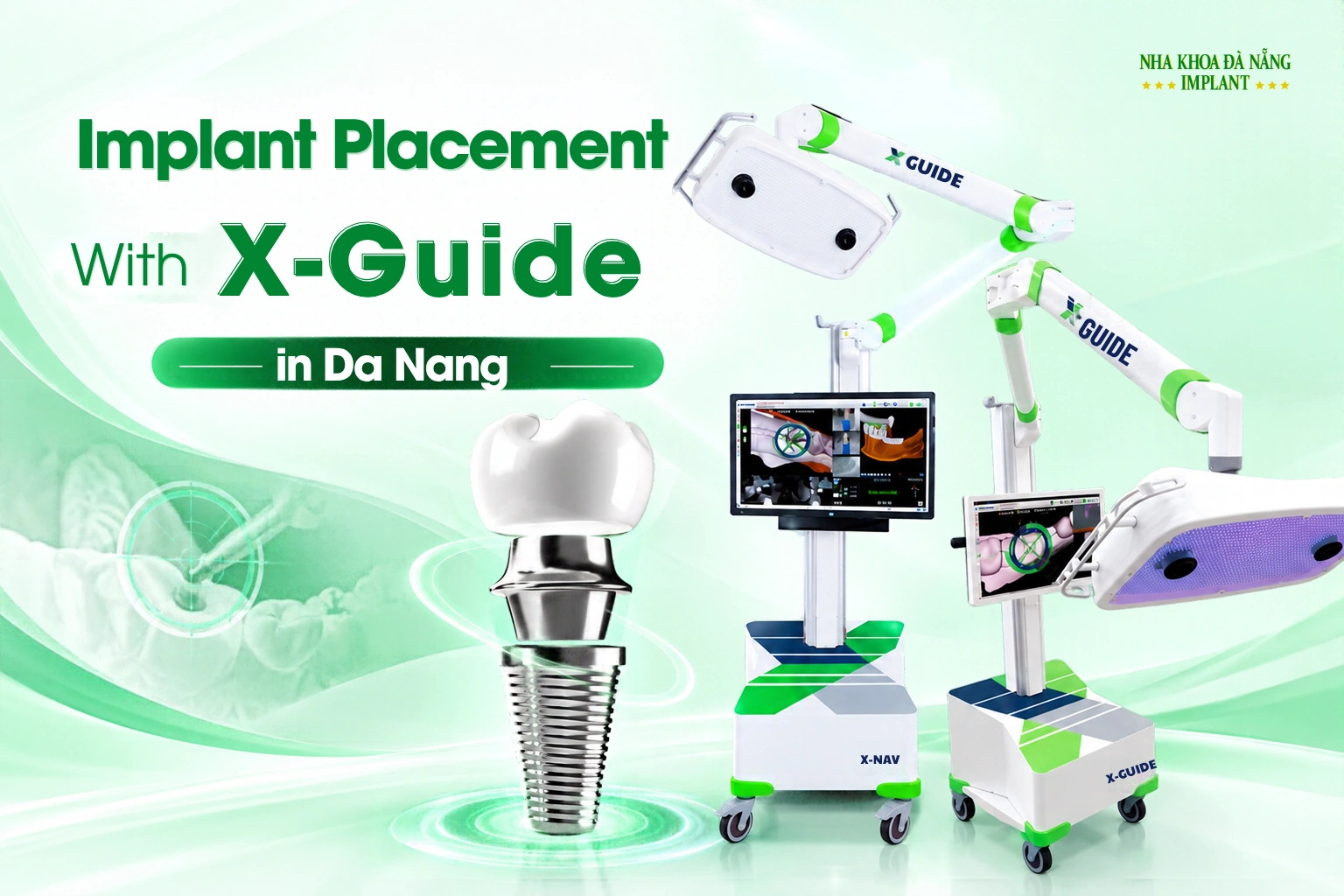 Dental Implants with X-Guide in Da Nang: The Role of Technology