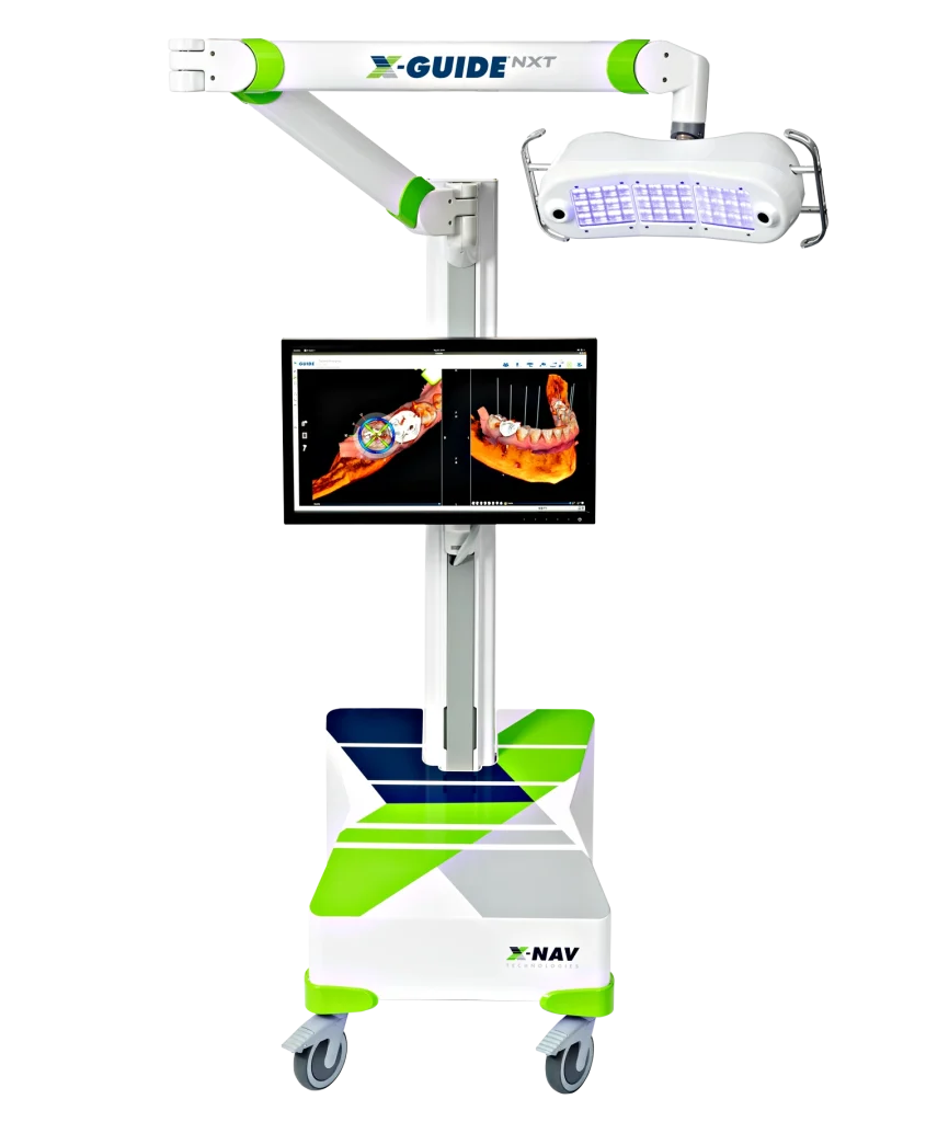 Trồng Implant với X-Guide tại Đà Nẵng: Vai trò công nghệ trong kế hoạch phục hồi răng 5 X-Guide là gì?