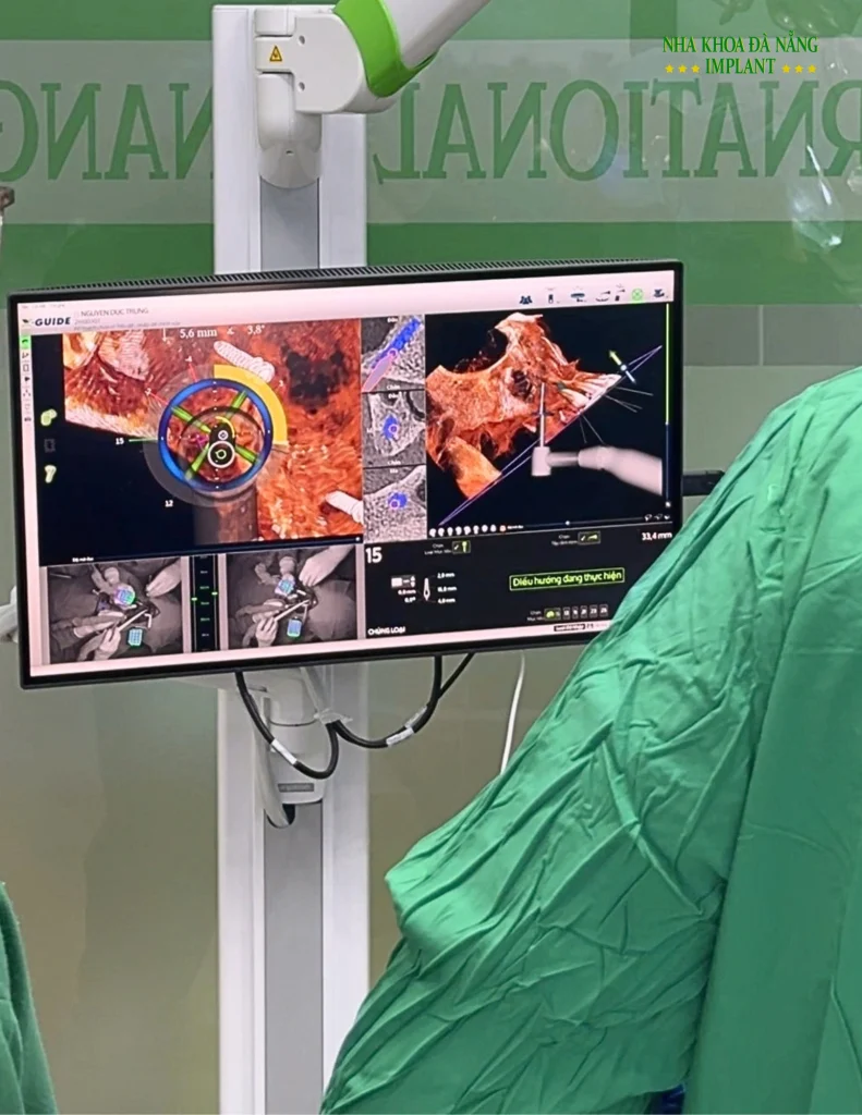 Trồng Implant với X-Guide tại Đà Nẵng: Vai trò công nghệ trong kế hoạch phục hồi răng 6 Vai trò của X-Guide trong kế hoạch phục hồi răng
