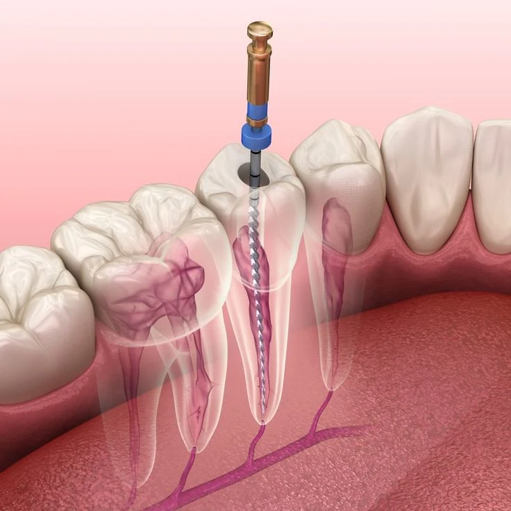 Sau Điều Trị Tủy Cần Lưu Ý Gì? Chăm Sóc Đúng Cách Để Giữ Răng Lâu Dài 6 Sau điều trị tuỷ cần lưu ý điều gì?
