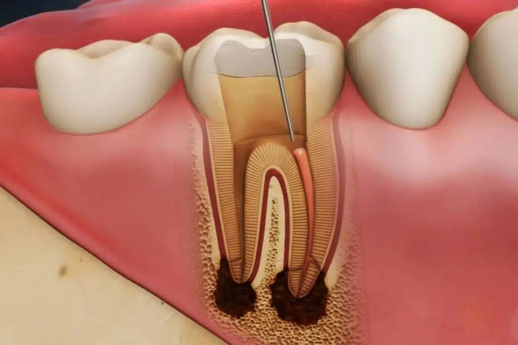 Supporting Complex Cases and Root Canal Retreatment